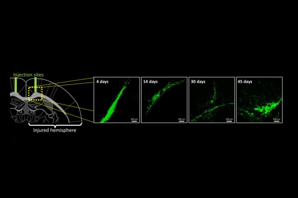 Transplantation of Neural Stem Cells Therapy | Kids Brain Health ...